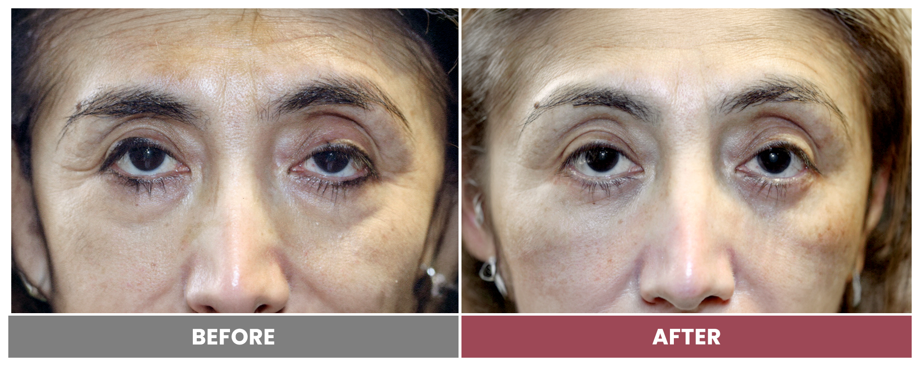 PTOSIS REPAIR - Case 57